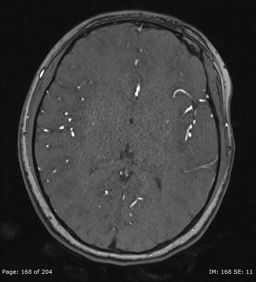 Balo concentric sclerosis (Radiopaedia 61637-69636 Axial MRA 168).jpg