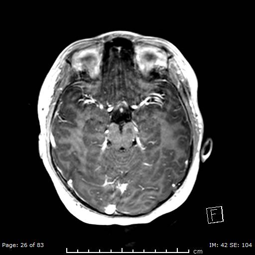 Balo concentric sclerosis (Radiopaedia 61637-69636 Axial T1 C+ 26).jpg