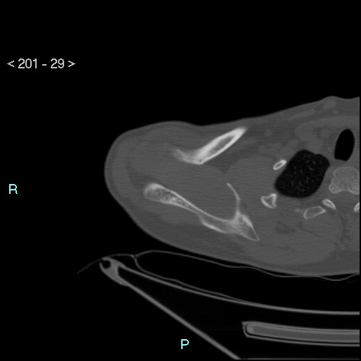 Bankart lesion with glenoid bone defect - assessment TC with PICO method (Radiopaedia 42855-93901 Axial bone window 28).jpg