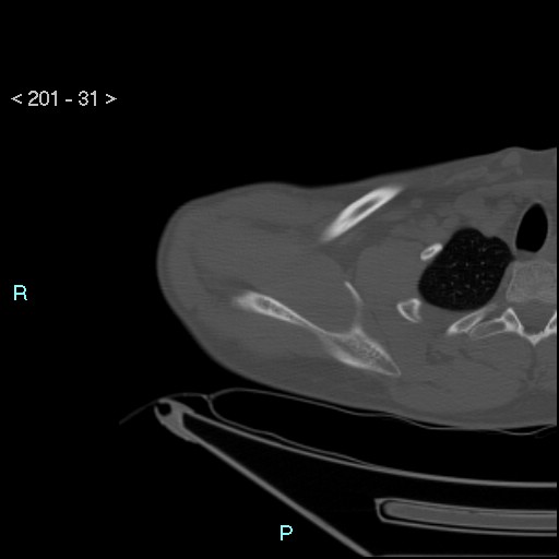 File:Bankart lesion with glenoid bone defect - assessment TC with PICO method (Radiopaedia 42855-93901 Axial bone window 30).jpg