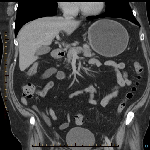 File:Bariatric balloon causing gastric outlet obstruction (Radiopaedia 54449-60672 B 25).jpg