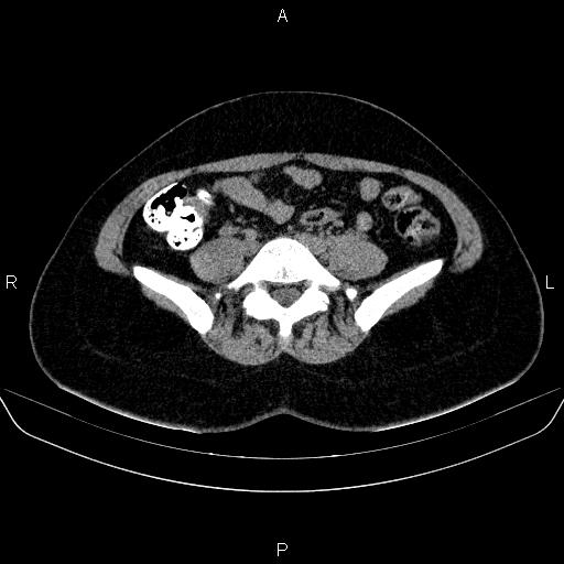 Bartholin gland cyst (Radiopaedia 62635-70930 Axial non-contrast 7).jpg