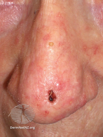 File:Basal cell carcinoma affecting the nose (DermNet NZ lesions-bcc-nose-1008).jpg