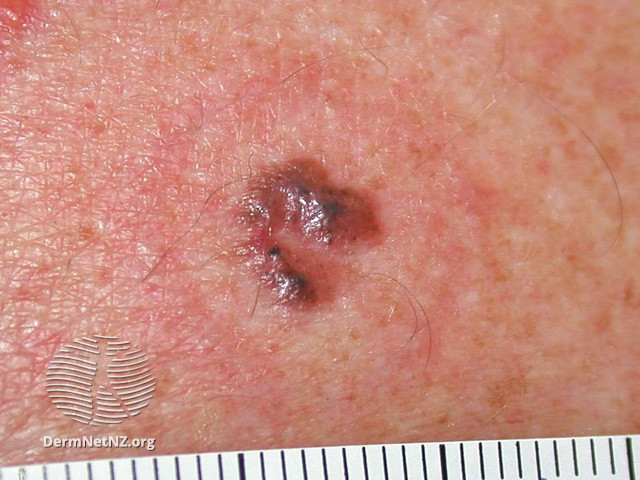 File:Basal cell carcinoma affecting the trunk (DermNet NZ lesions-bcc-trunk-0804).jpg