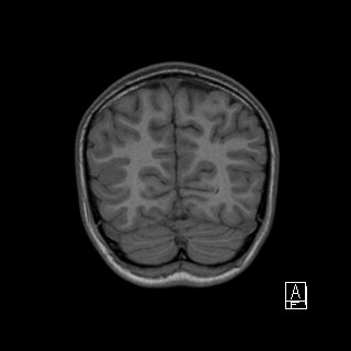 Base of skull rhabdomyosarcoma (Radiopaedia 32196-33142 Coronal T1 42).jpg