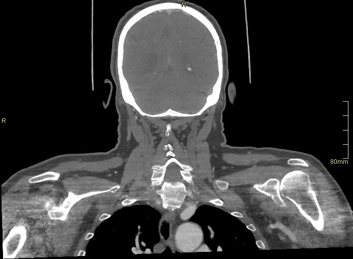 Basilar artery aneurysm (Radiopaedia 56261-62932 B 53).jpg