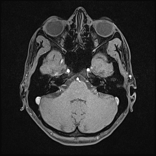 Basilar artery perforator aneurysm (Radiopaedia 82455-97733 Axial T1 fat sat 35).jpg