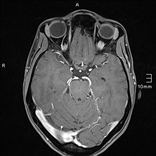 Basilar artery perforator aneurysm (Radiopaedia 82455-99523 G 51).jpg