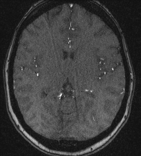 Basilar tip aneurysm (Radiopaedia 26504-26632 MRA 129).jpg