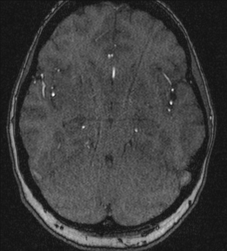 Basilar tip aneurysm (Radiopaedia 26504-26632 MRA 92).jpg