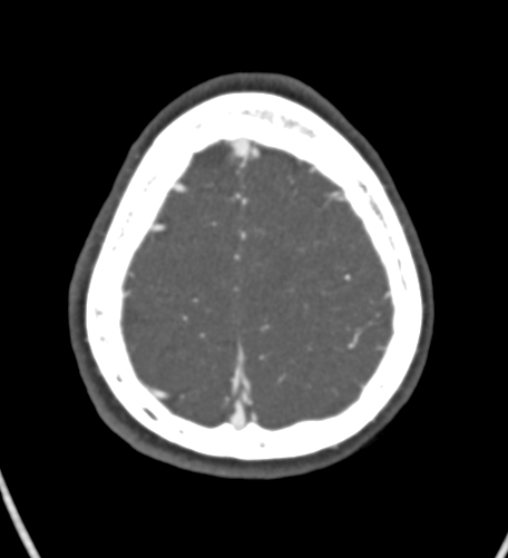 Basilar tip aneurysm with coiling (Radiopaedia 53912-60086 A 128).jpg