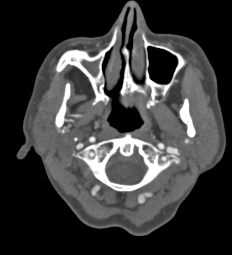 Basilar tip aneurysm with coiling (Radiopaedia 53912-60086 A 6).jpg