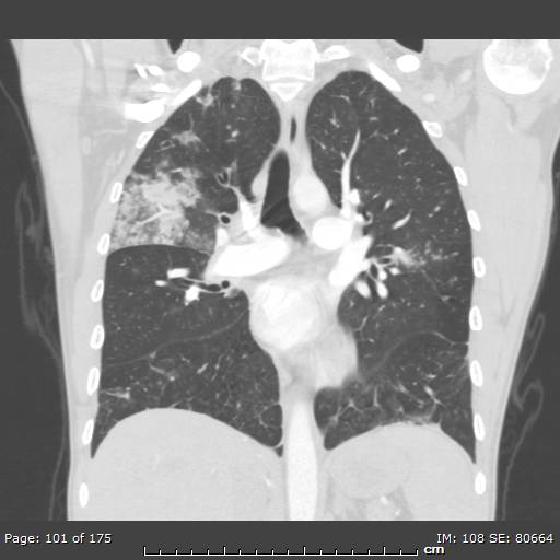 File:Behçet disease (Radiopaedia 44247-47889 Coronal lung window 30).jpg