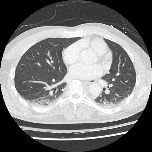 Benign post-traumatic pseudopneumoperitoneum (Radiopaedia 71199-81495 Axial lung window 43).jpg