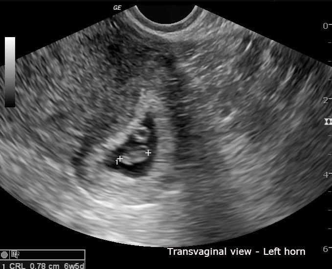 File:Bicornuate uterus with early pregnency (Radiopaedia 23147-23191 C 1).jpg
