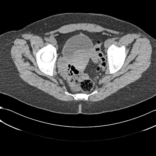 Bilateral acetabular protrusion with pincer type femoro-acetabular impingement (Radiopaedia 30134-30733 AXIAL SOFT THIN 26).jpg