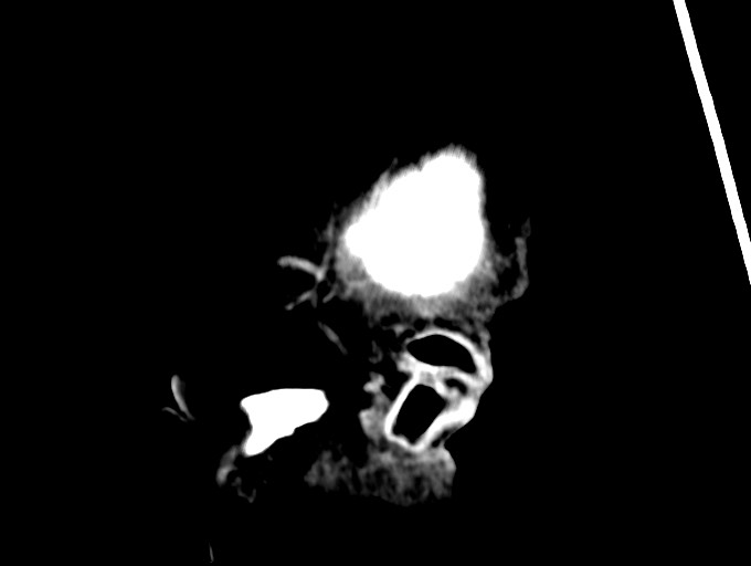 Bilateral acute on chronic subdural hematomas (Radiopaedia 78466-91146 C 53).jpg
