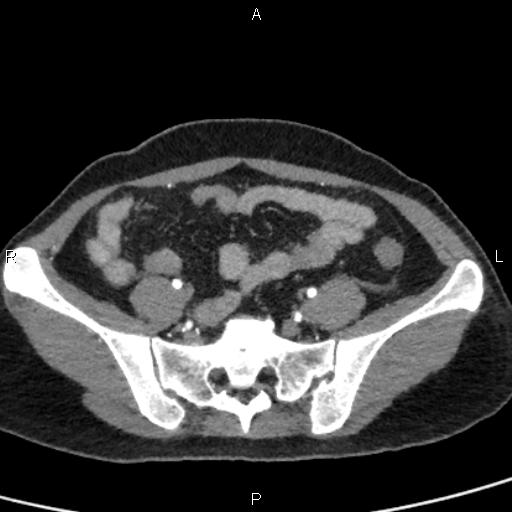 Bilateral adrenal gland hyperenhancement in pancreatitis (Radiopaedia 86642-102753 B 100).jpg