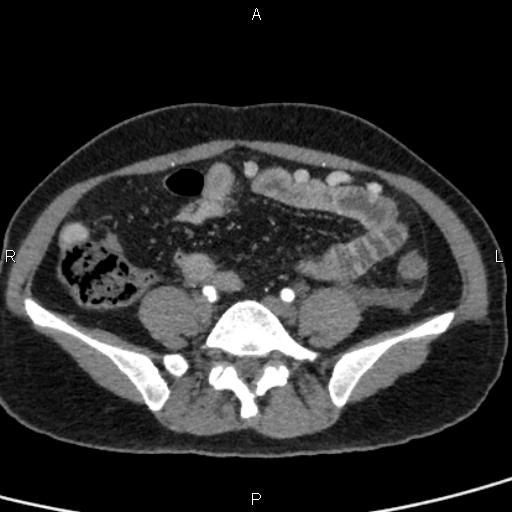 Bilateral adrenal gland hyperenhancement in pancreatitis (Radiopaedia 86642-102753 B 93).jpg