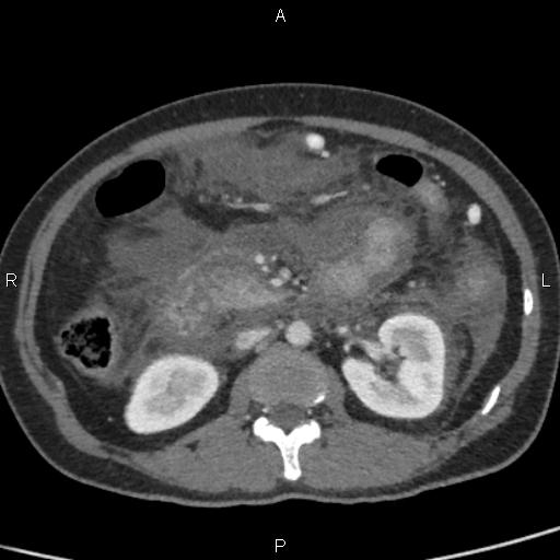 Bilateral adrenal gland hyperenhancement in pancreatitis (Radiopaedia 86642-102753 E 49).jpg