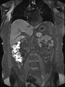 Bilateral adrenal myelolipoma (Radiopaedia 63058-71537 Coronal T1 fat sat 58).jpg