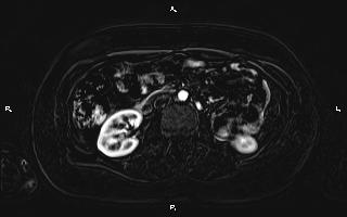 Bilateral adrenal myelolipoma (Radiopaedia 63058-71537 I 55).jpg