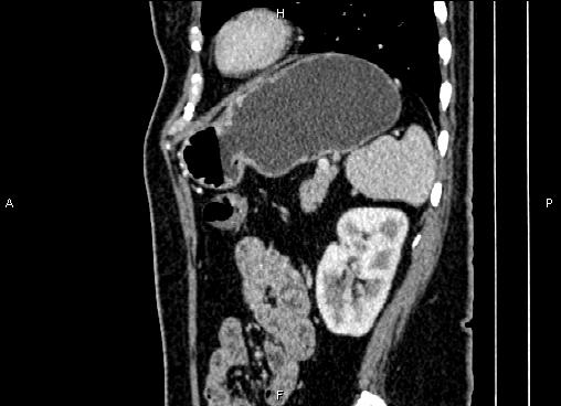 Bilateral benign adrenal adenomas (Radiopaedia 86912-103124 E 75).jpg