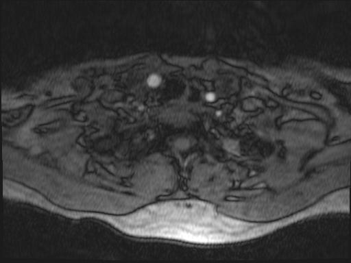 Bilateral carotid body tumors and right glomus jugulare tumor (Radiopaedia 20024-20060 Axial MRA 189).jpg