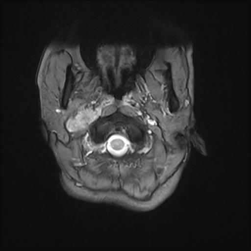 File:Bilateral carotid body tumors and right jugular paraganglioma (Radiopaedia 20024-20060 Axial 71).jpg