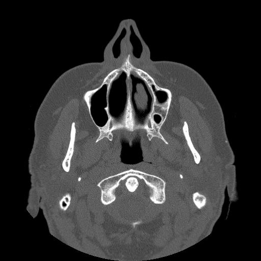 File:Bilateral ectopic infraorbital nerves (Radiopaedia 49006-54084 Axial 14).jpg
