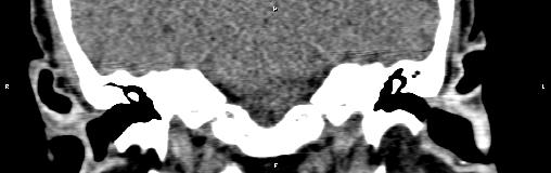 File:Bilateral enlargement of lacrimal glands - sarcoidosis (Radiopaedia 62627-70921 Coronal non-contrast 34).jpg