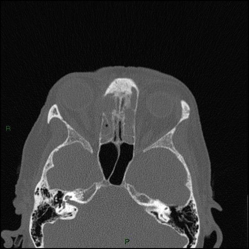 Bilateral frontal mucoceles (Radiopaedia 82352-96454 Axial bone window 138).jpg