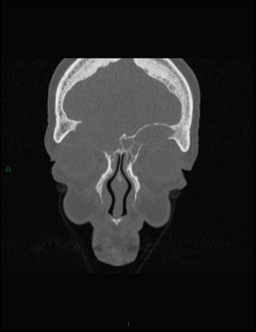 Bilateral frontal mucoceles (Radiopaedia 82352-96454 Coronal 79).jpg