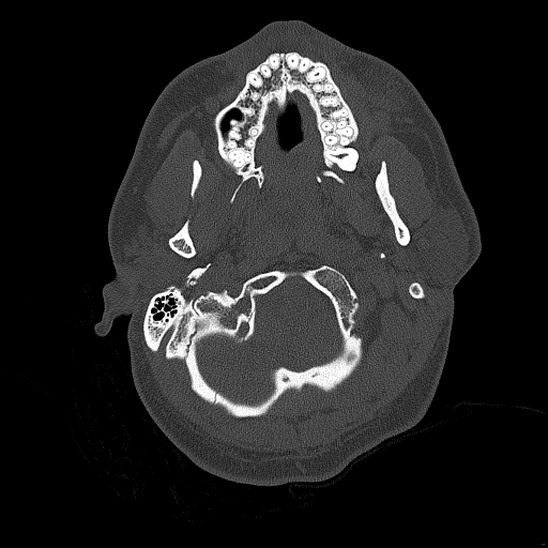 Bilateral occipital condyle fracture (type 2) (Radiopaedia 87675-104089 Axial bone thins 19).jpg