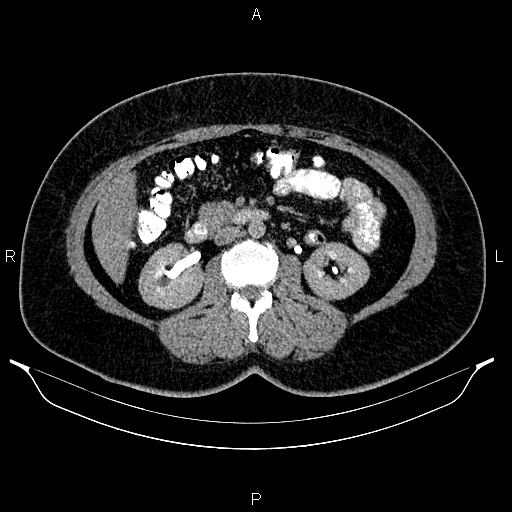 Bilateral ovarian dermoid cysts (Radiopaedia 85785-101603 Axial C+ delayed 32).jpg