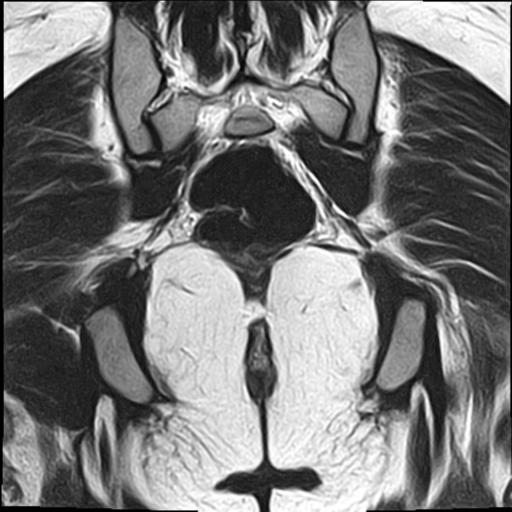 File:Bilateral ovarian endometriomas (Radiopaedia 87085-103347 Coronal T2 19).jpg