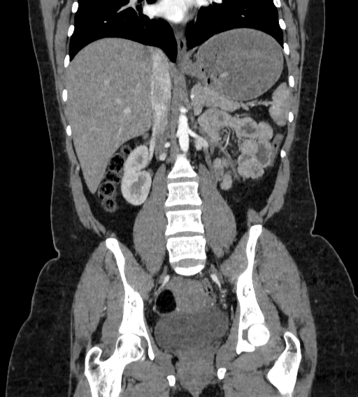 File:Bilateral ovarian mature cystic teratomas (Radiopaedia 79373-92457 B 44).jpg