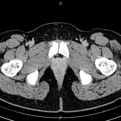 Bilateral ovarian teratoma (Radiopaedia 83131-97503 B 83).jpg