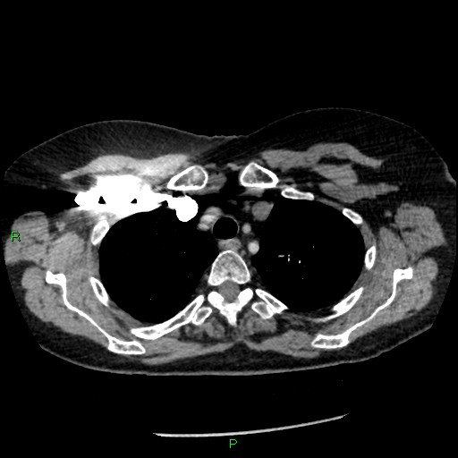 File:Bilateral pulmonary emboli (Radiopaedia 32700-33669 Axial C+ CTPA 18).jpg