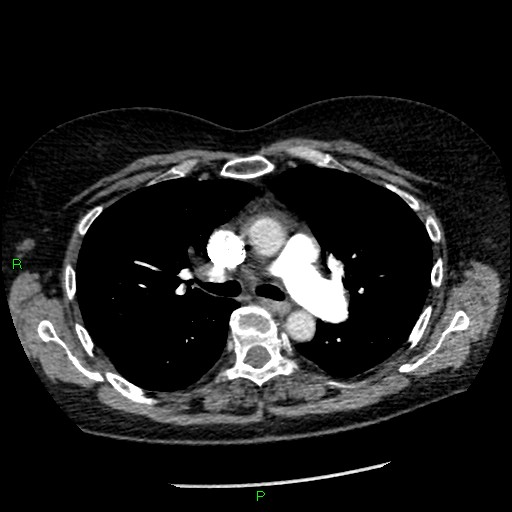 Bilateral pulmonary emboli (Radiopaedia 32700-33669 Axial C+ CTPA 43).jpg