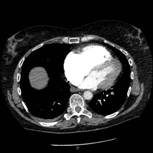 Bilateral pulmonary emboli (Radiopaedia 32700-33669 Axial C+ CTPA 75).jpg