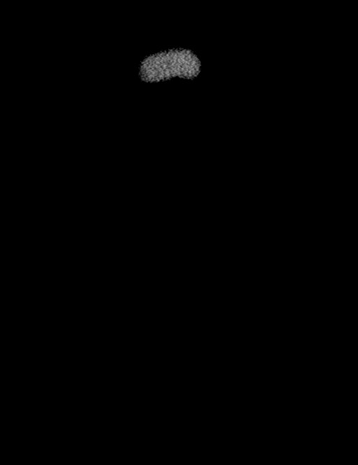 Bilateral staghorn calculi (Radiopaedia 59475-66842 Coronal non-contrast 18).jpg