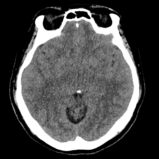 Bilateral subacute subdural hematoma (Radiopaedia 69240-79018 Axial non-contrast 21).jpg
