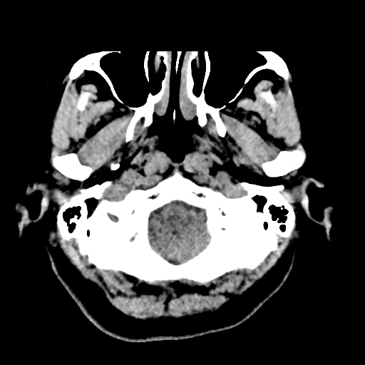 Bilateral subacute subdural hematoma (Radiopaedia 69240-79018 Axial non-contrast 5).jpg