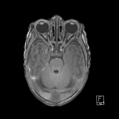 Bilateral subdural hemorrhage and parietal skull fracture (Radiopaedia 26058-26190 Axial T1 16).png
