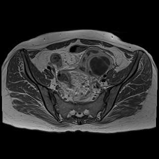 Bilateral tubo-ovarian abscesses (Radiopaedia 58635-65829 Axial T1 C+ 17).jpg