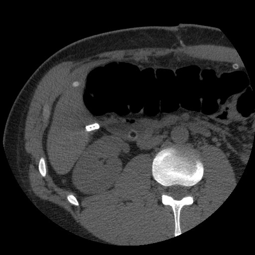 Bile leak from liver traumatic laceration (Radiopaedia 63463-72077 Axial Biliscopin 68).jpg