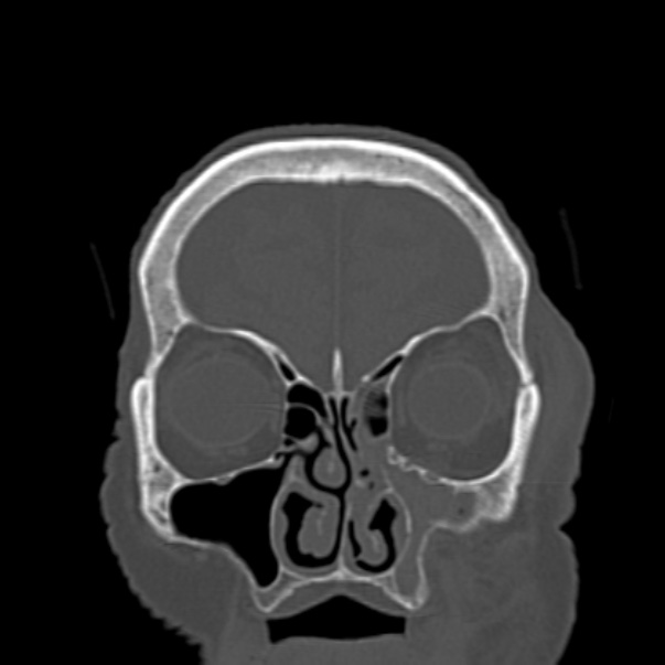 Biparietal osteodystrophy (Radiopaedia 46109-50463 Coronal bone window 25).jpg