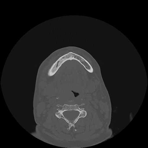 File:Bisphosphonate-related osteonecrosis of the jaw (Radiopaedia 71324-81642 Axial bone window 32).jpg