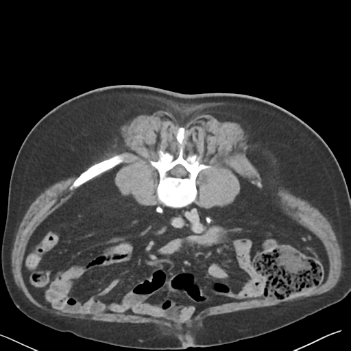 File:Bladder papillary urothelial carcinoma (Radiopaedia 48119-52951 Axial C+ delayed 31).png